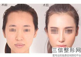 上海隆鼻好的整形医院排名榜前四强公布,上海鼻部整形医院排名前三的
