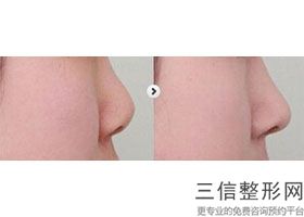 上海隆鼻较好的整形医院排名榜前五公示,上海隆鼻那家整形医院好