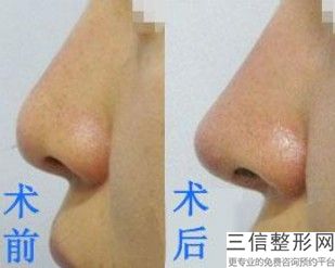 上海隆鼻医生排名前十权威盘点,上海隆鼻比较好的医生