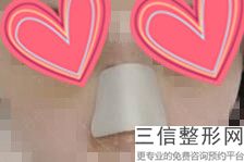 上海隆鼻医院排行榜前五强权威推荐,国内医院隆鼻排名