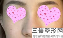 上海隆鼻医院排行榜前五强权威推荐,国内医院隆鼻排名