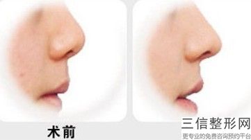 上海隆鼻整形美容医院排行榜前十,上海鼻子整形医院排名前十