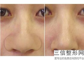上海隆鼻整形医院排行榜十强权威测评,上海哪家医院隆鼻子技术良好