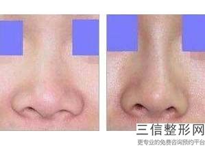 上海隆鼻整形医院排名榜六强权威盘点,上海哪家医院隆鼻子技术良好