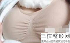 上海隆胸三甲医院排名表单及坐诊医生实力案例图大PK,上海做隆胸手术哪家医院好