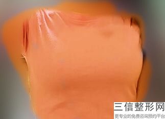 上海隆胸整形医院排名榜top5在此,上海隆胸哪个医院比较好