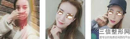 上海权威鼻子整形医院排名前五公布,上海哪个医院鼻整形好