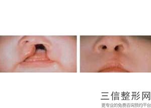 上海市做嘴唇整形医院排行榜前五位,上海哪家医院做嘴唇手术好一点