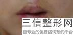 上海市做嘴唇整形医院排行榜前五位,上海哪家医院做嘴唇手术好一点