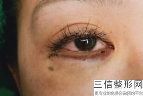 上海双眼皮修复较好的医院有哪些,上海双眼皮修复医院排名