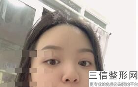 上海双眼皮修复较好的医院有哪些,上海双眼皮修复医院排名
