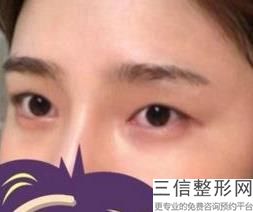 上海双眼皮医生排名前十榜单推荐,上海做双眼皮医生排名