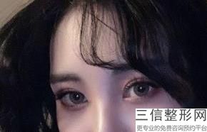 上海双眼皮整形医院排行前十名单出炉,上海良好双眼皮医院