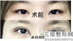 上海双眼皮整形医院排名榜八强重磅更新,上海较好的双眼皮医院