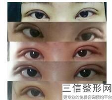 上海双眼皮整形医院排名榜八强重磅更新,上海较好的双眼皮医院