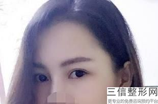 上海双眼皮整形医院排名前十榜单选定,上海良好双眼皮医院