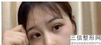 上海双眼皮整形医院排名前十榜单选定,上海良好双眼皮医院
