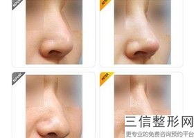 隆鼻假体保持时间，假体隆鼻的恢复期