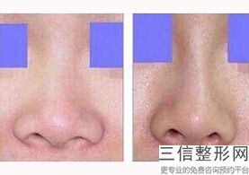 隆鼻假体寿命有多长，假体隆鼻是终身的吗