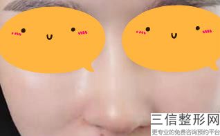 隆鼻哪里整形医院好，隆鼻好的医院美容