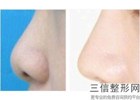 隆鼻手术哪家整形医院比较好，哪个医院做隆鼻整形好