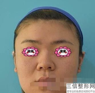 隆鼻手术危险么，隆鼻手术有必要吗