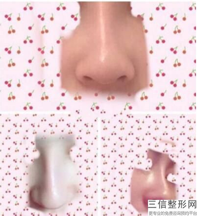 隆鼻手术危险么，隆鼻手术有必要吗