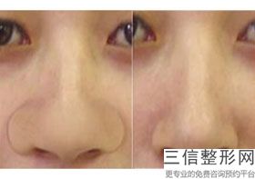 隆鼻手术有哪几种方法，隆鼻子方法有哪些