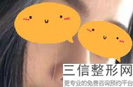 隆鼻手术有哪几种方法，隆鼻子方法有哪些