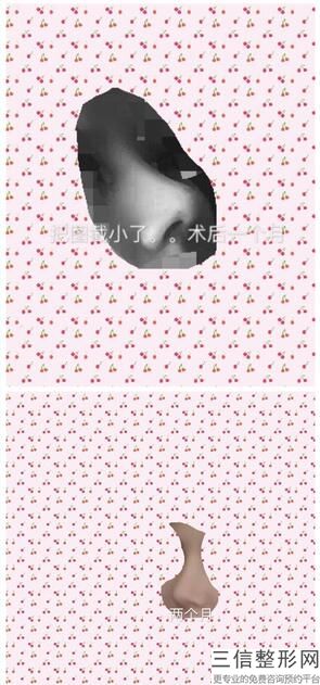 隆鼻修复假体需要更换吗，假体隆鼻可以直接换假体