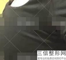 隆胸减肥整形医院，减肥隆胸手术