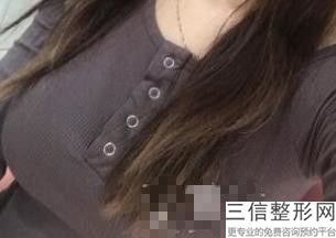 隆胸手术的费用是多少,做隆胸手术费用大概多少钱