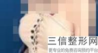 隆胸手术多少钱(女人做隆胸手术多少钱)