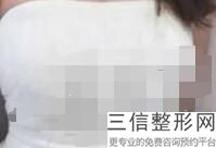 隆胸手术整容医院，整形手术隆胸医院