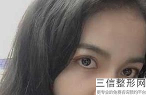埋线双眼皮哪家做的好，做埋线双眼皮手术哪里好