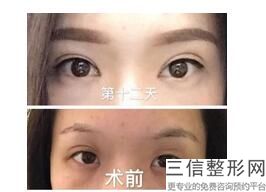 埋线双眼皮哪家做的好，做埋线双眼皮手术哪里好