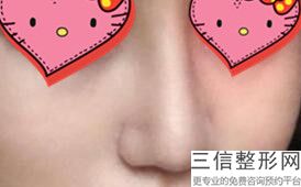 哪个医院隆鼻做得好,隆鼻隆鼻那里好