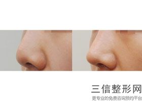 哪个医院做隆鼻整形好,隆鼻整形术哪家医院好
