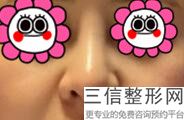 哪个医院做隆鼻整形好,隆鼻整形术哪家医院好