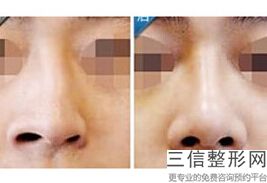 哪家医院做隆鼻比较好,隆鼻在哪个医院好
