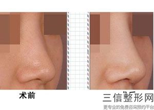 哪家医院做隆鼻手术好，哪家医院做隆鼻比较好