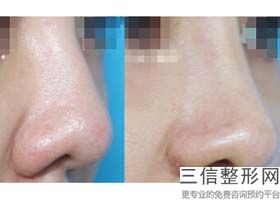 哪家整形医院做隆鼻良好，隆鼻整形那家医院好