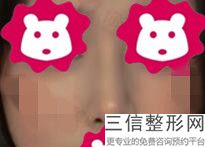 哪家整形医院做隆鼻良好，隆鼻整形那家医院好