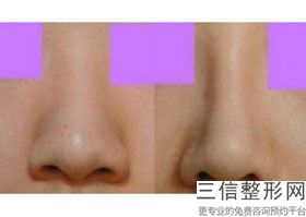 哪家整形医院做隆鼻良好，隆鼻整形医院那里好