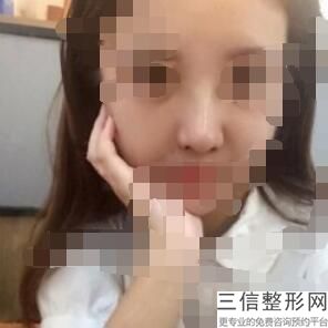 哪里医院做隆鼻手术好,做个隆鼻医院