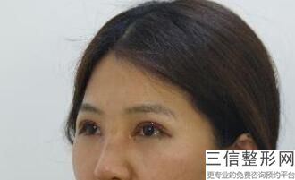 哪里做双眼皮比较便宜，做双眼皮要价格实惠
