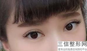 内双可以做双眼皮手术吗，内双能不能做双眼皮