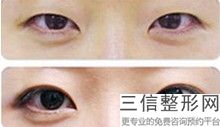 内双可以做双眼皮手术吗，内双能不能做双眼皮