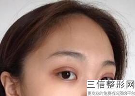 内双能做双眼皮手术吗，单眼皮可以做内双手术吗