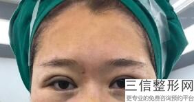 内双能做双眼皮手术吗，单眼皮可以做内双手术吗